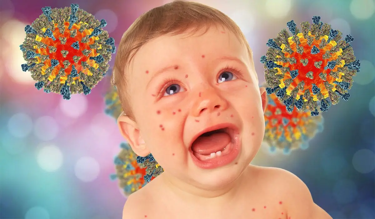 Measles Outbreak Forces DaycareM Centers to Close, Raising Health Alarms Nationwide